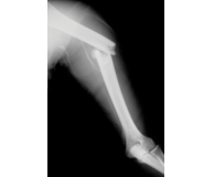 The Biochemistry of Osteoporosis